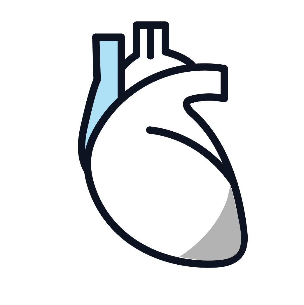 This is an image of stage 2 pericardial mesothelioma.