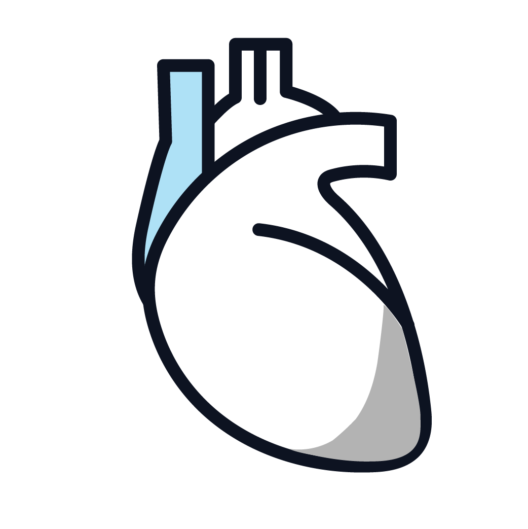 This is an image of stage 3 pericardial mesothelioma.