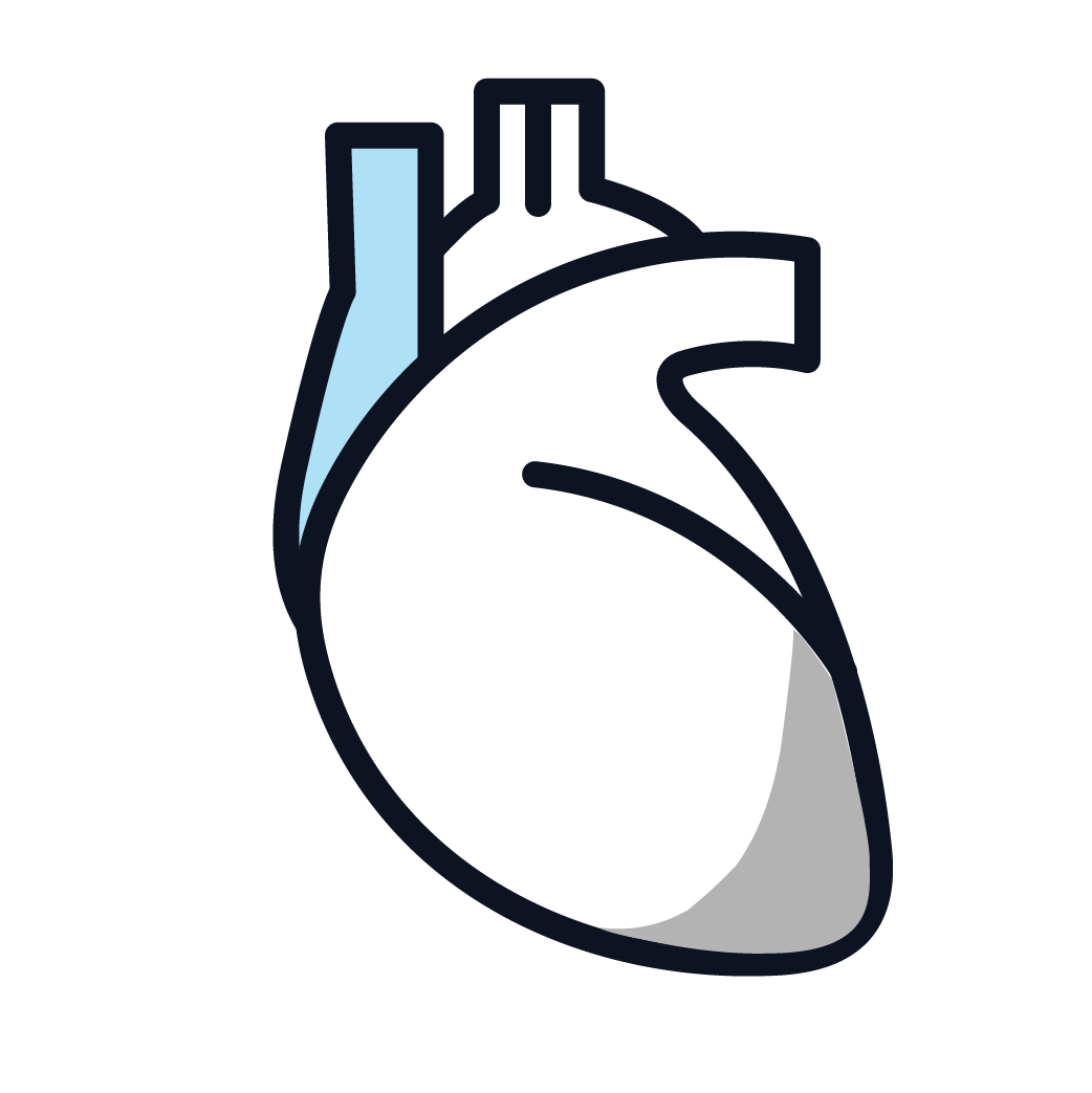 This is an image of pericardial mesothelioma.