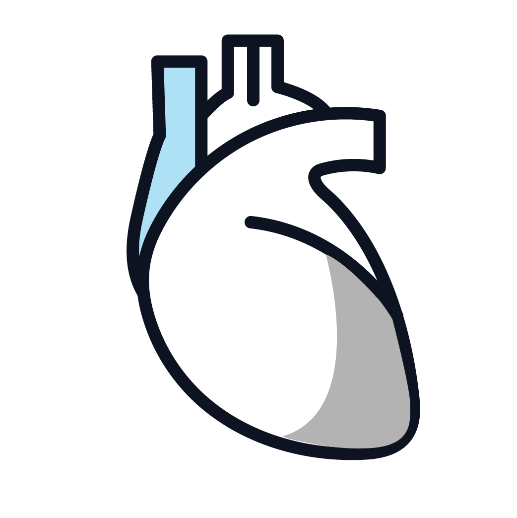 This is an image of stage 4 pericardial mesothelioma.