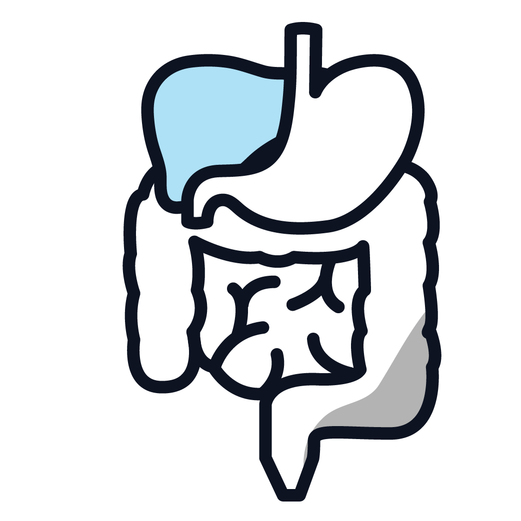 This is an image of stage 2 peritoneal mesothelioma.