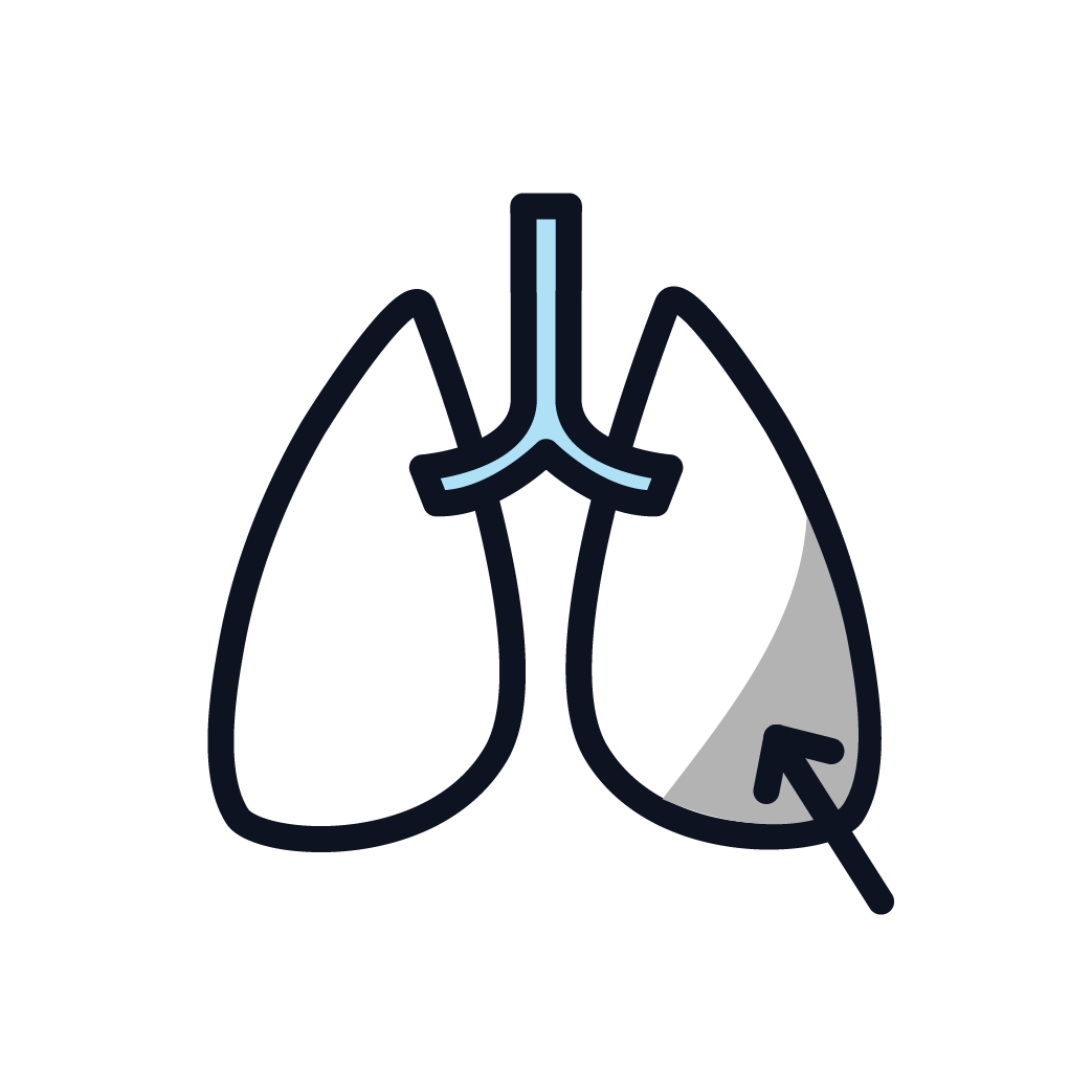 This is an icon showing fluid in the lung that needs to be drained.