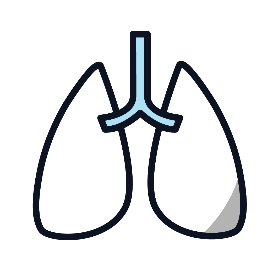 This is an image of a lung with stage 1 cancer.