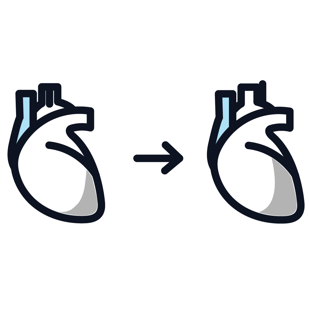 This is an image representing stages 3 and 4 of mesothelioma.