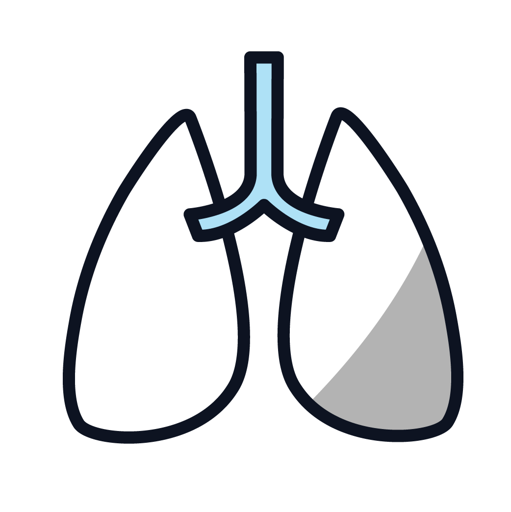 This is an image of pleural mesothelioma.