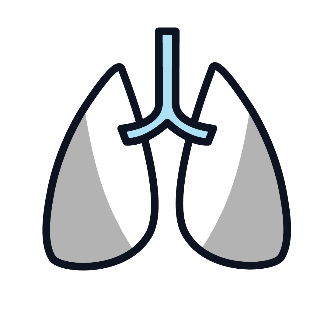 This is an image of a lung with stage 4 cancer.