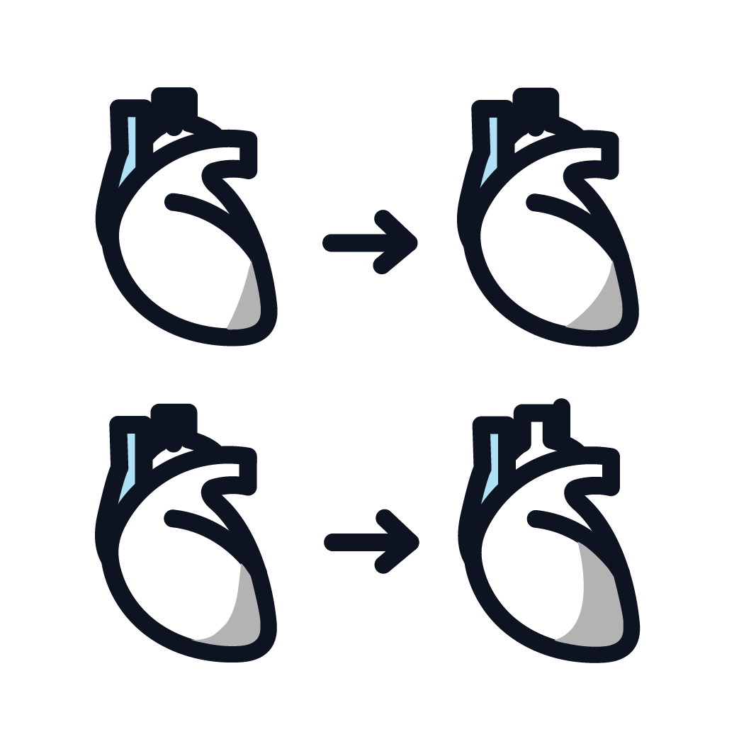 This is an icon showing the 4 different stages of mesothelioma.