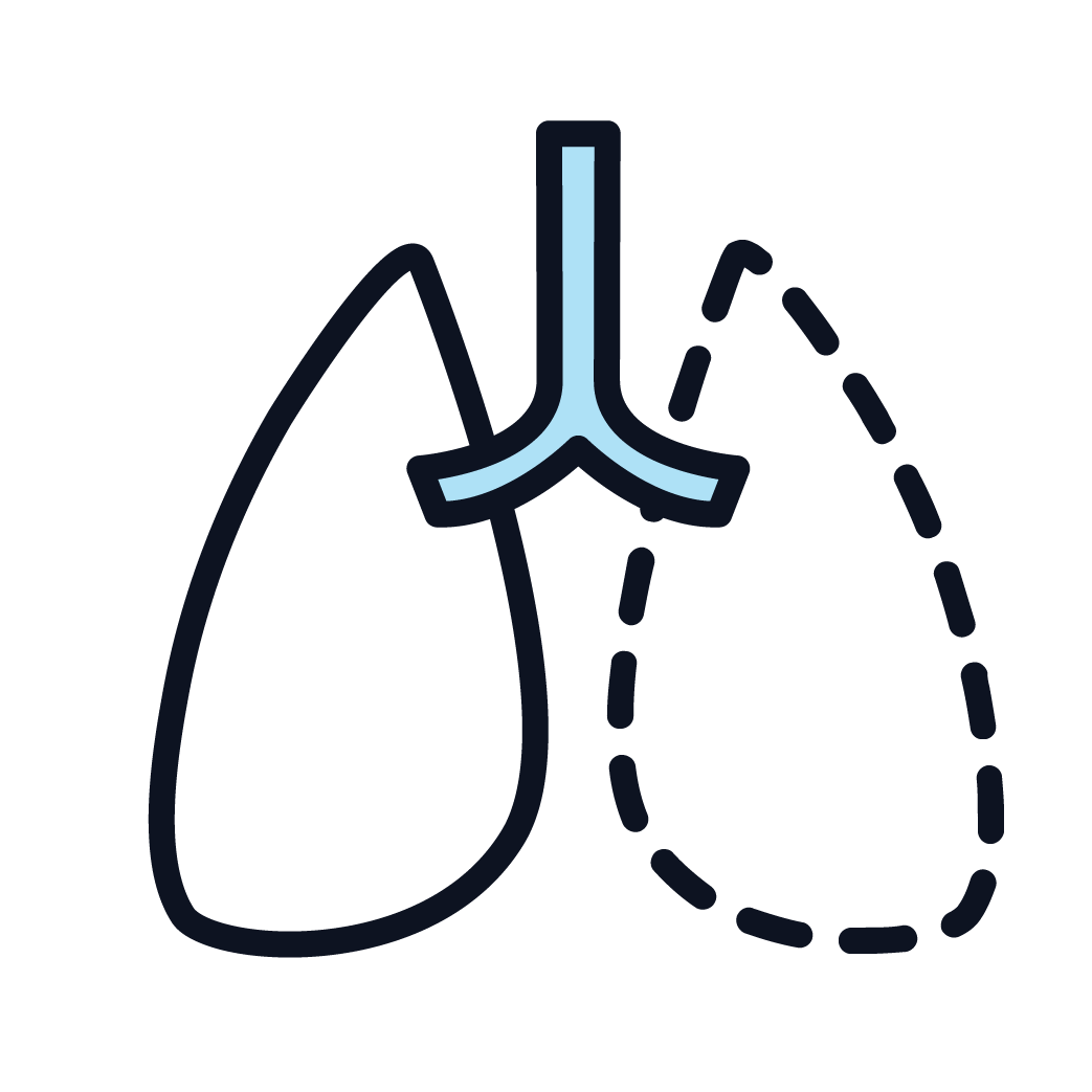 This is an icon displaying mesothelioma surgery.