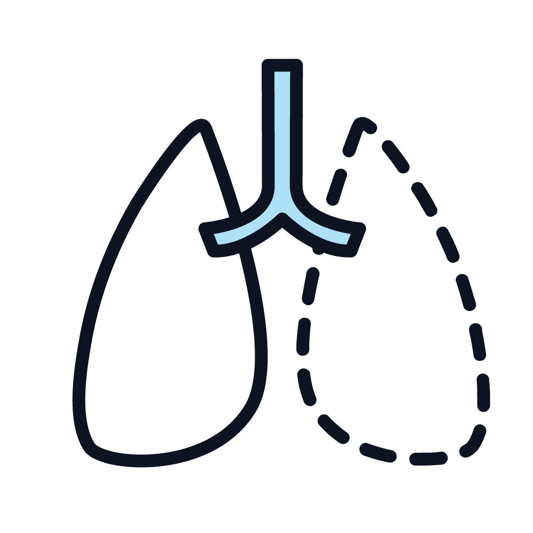 Cartoon drawing of the lungs with one lobe gone and outlined by dashes