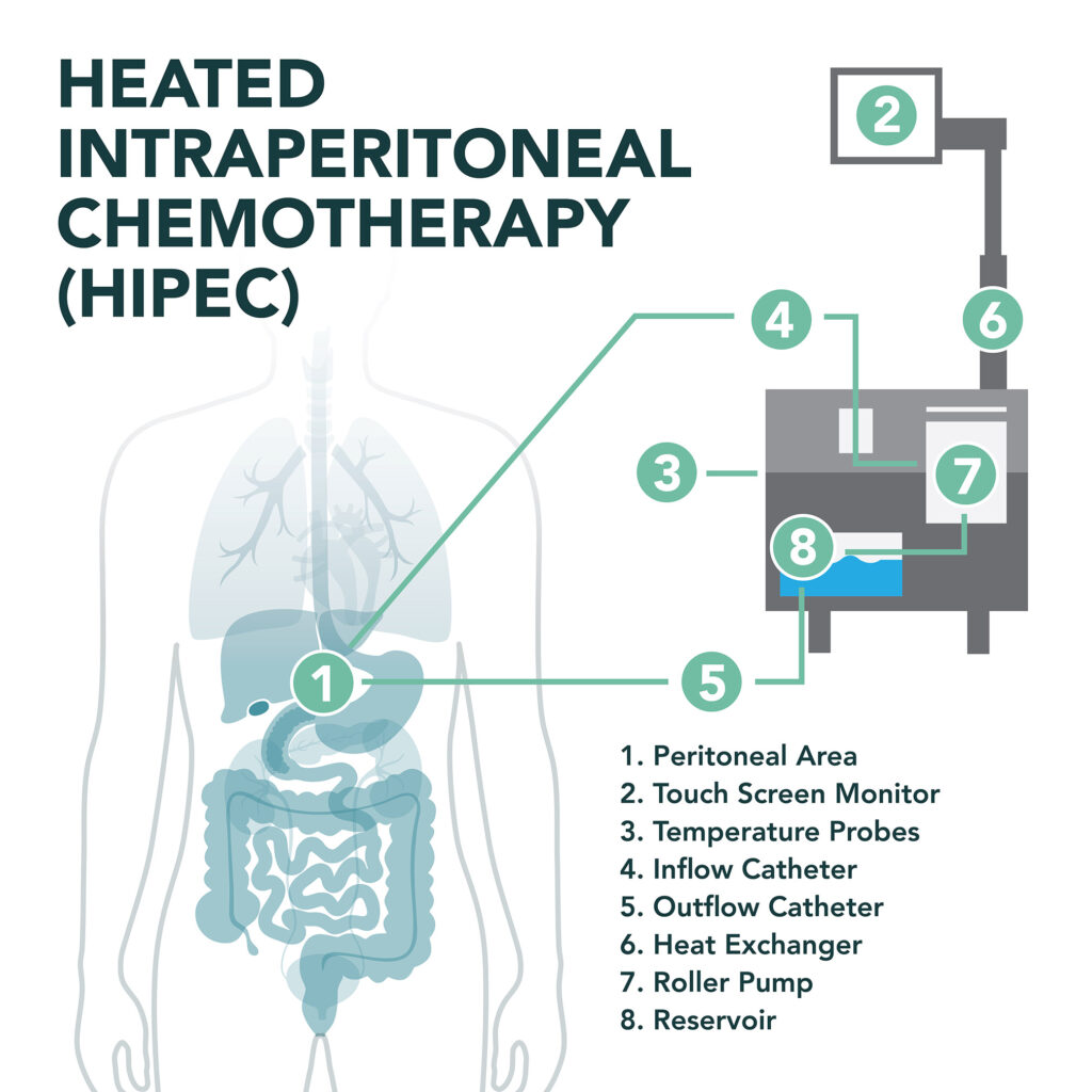 HIPEC infographic