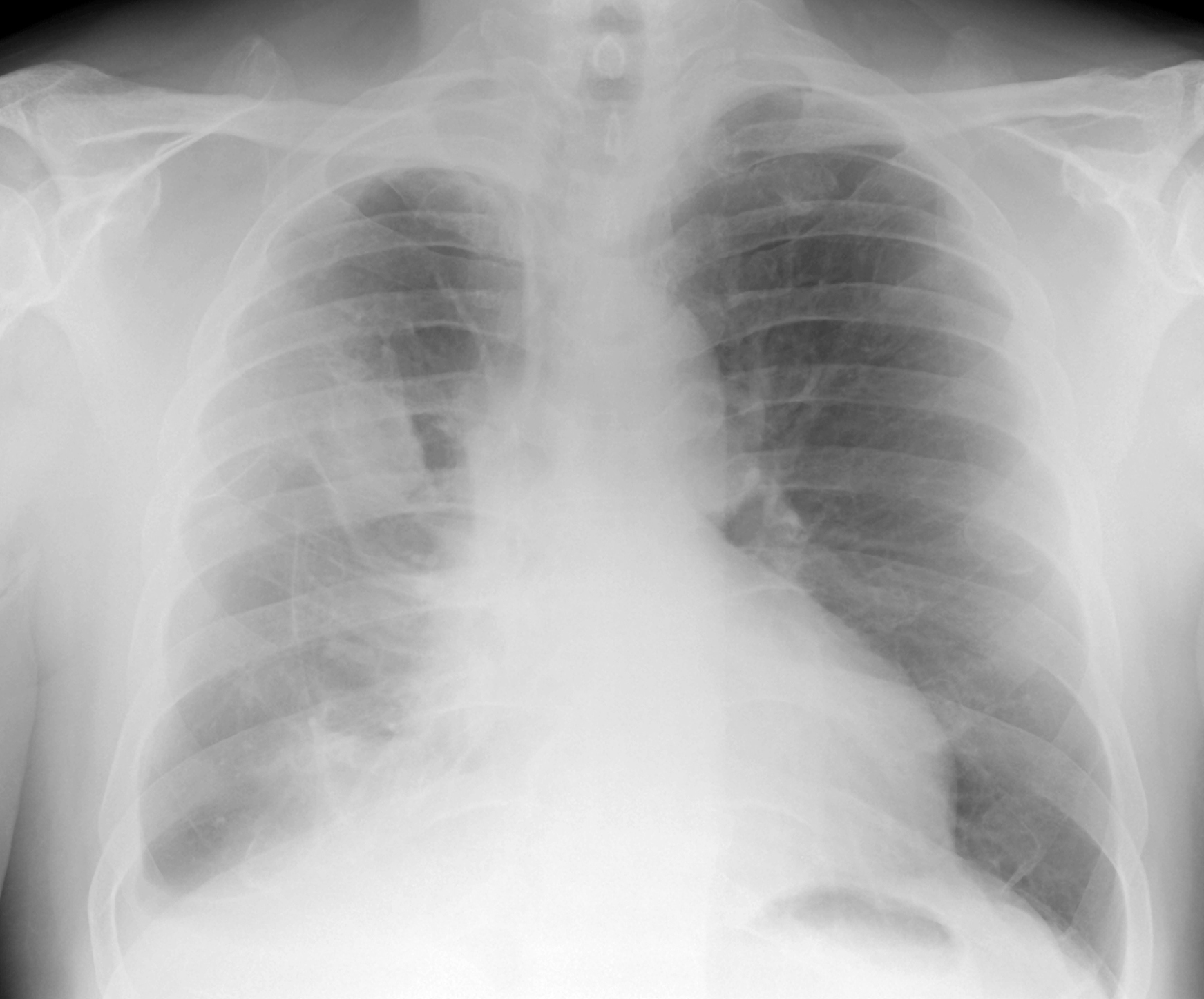 Chatham Mesothelioma Legal Actions: Seeking Justice For Asbestos Victims