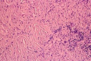 Microphotograph of mesothelioma that features granulation and fibrous pleuritis.