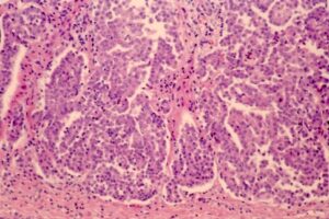 Microphotograph of epithelioid mesothelioma with papillo-tubular structure