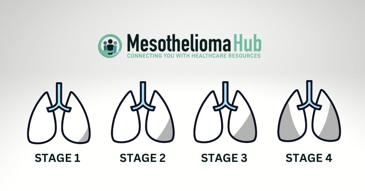 Mesothelioma progression in stages one, two, three, and four