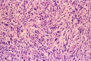 Microphotograph of sarcomatoid mesothelioma with proliferation of spindle cells