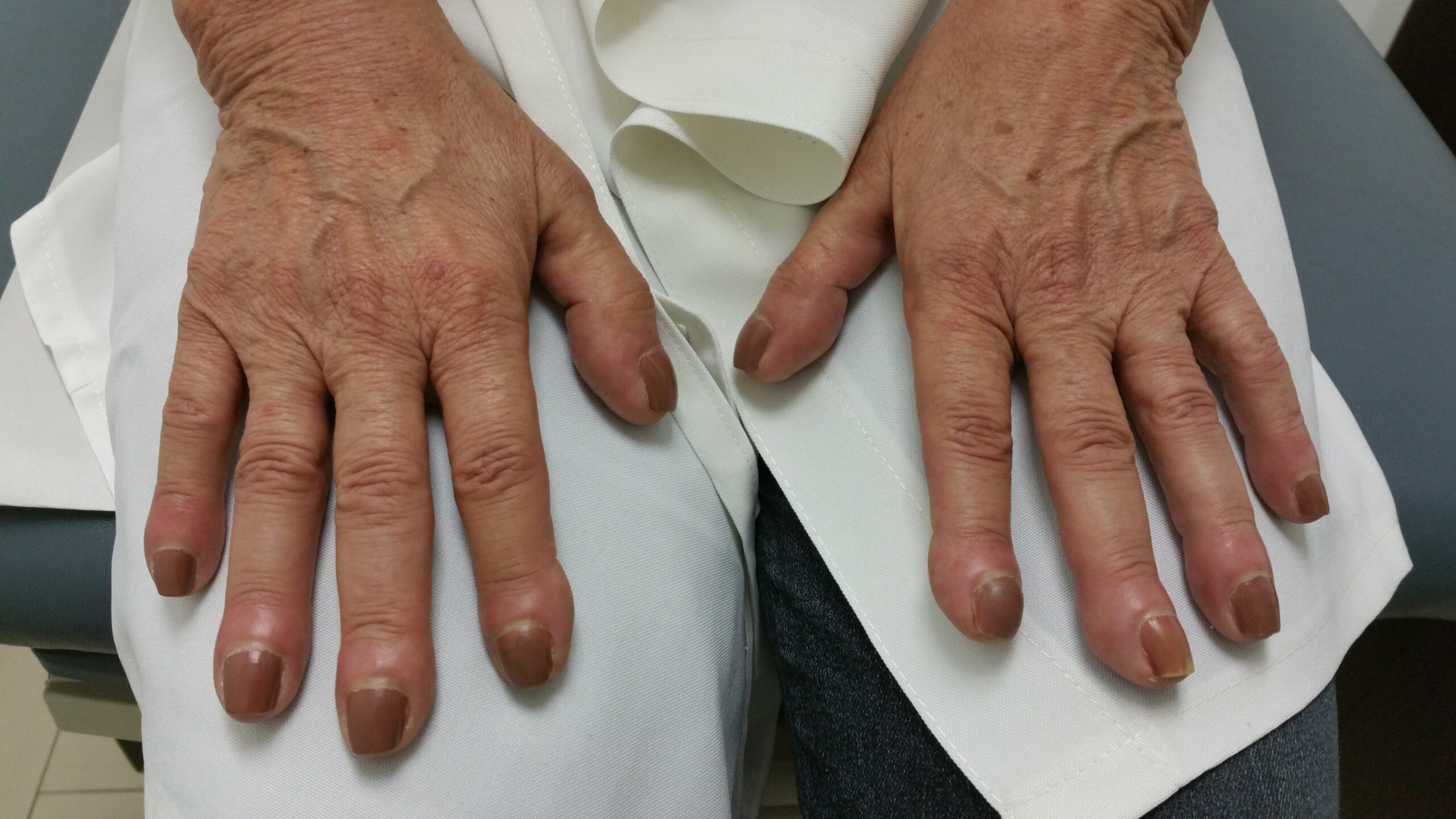 Two hands laying flat on a table showing finger clubbing