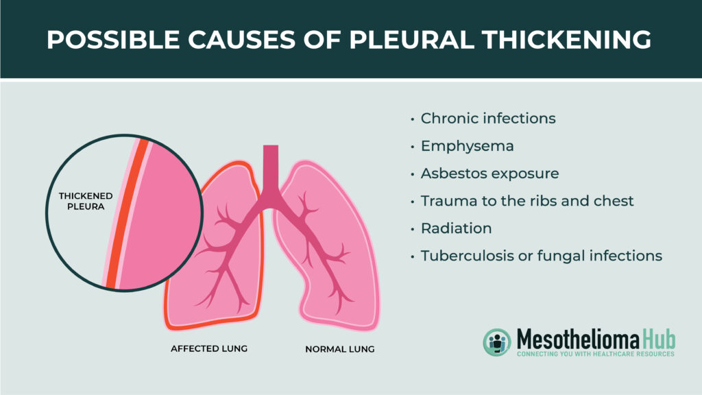A graphic lung showing pleural thickening of the lung lining and some potentially causes of it.