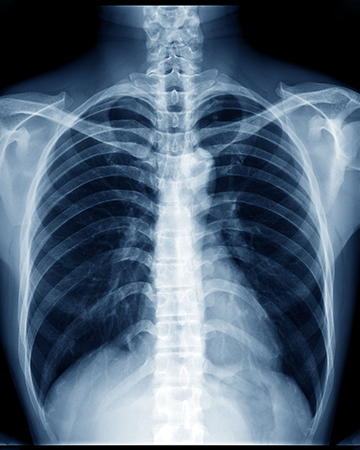 A chest X-ray showing the healthy lungs of a person.
