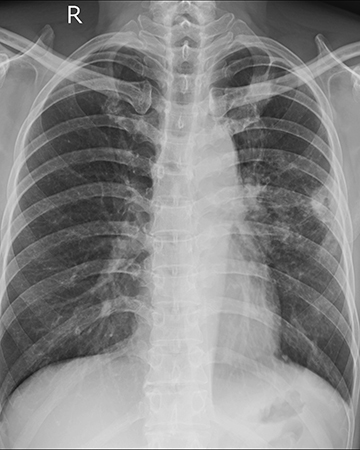 A chest X-ray showing pleural thickening, or wedge-shaped deformities at the tops of the lungs.