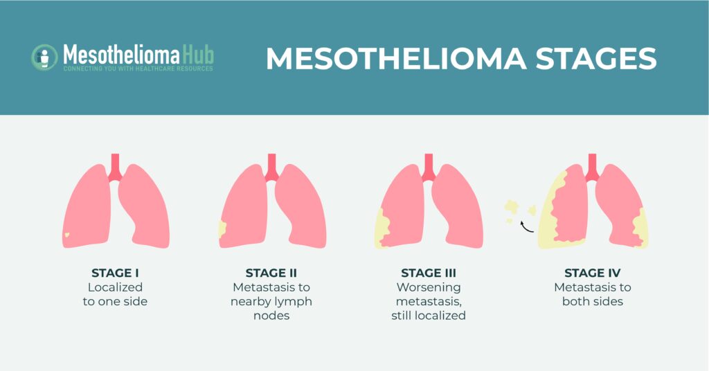Infographic detailing the four stages of mesothelioma cancer