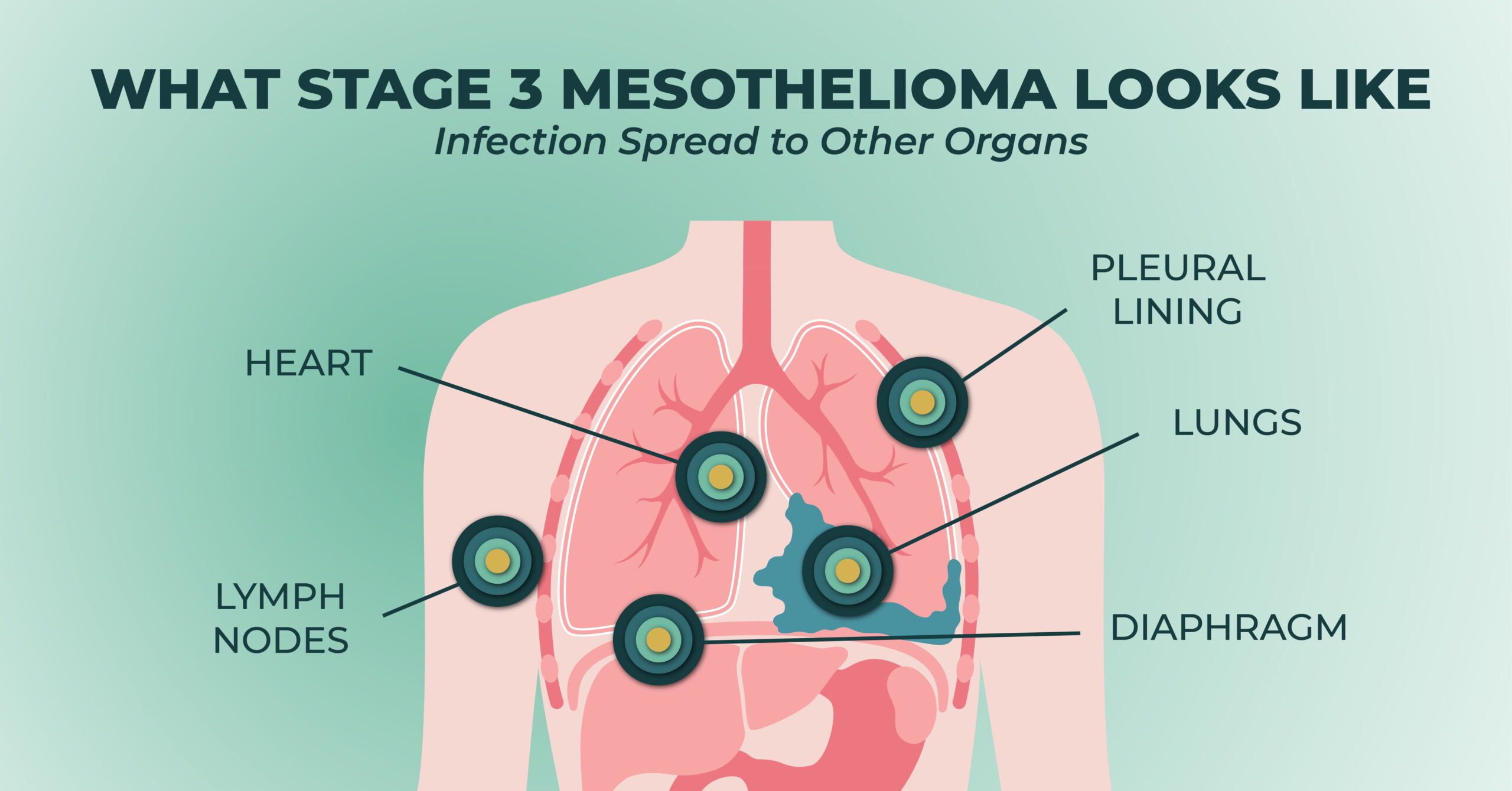 What stage 3 mesothelioma looks like inside the body.