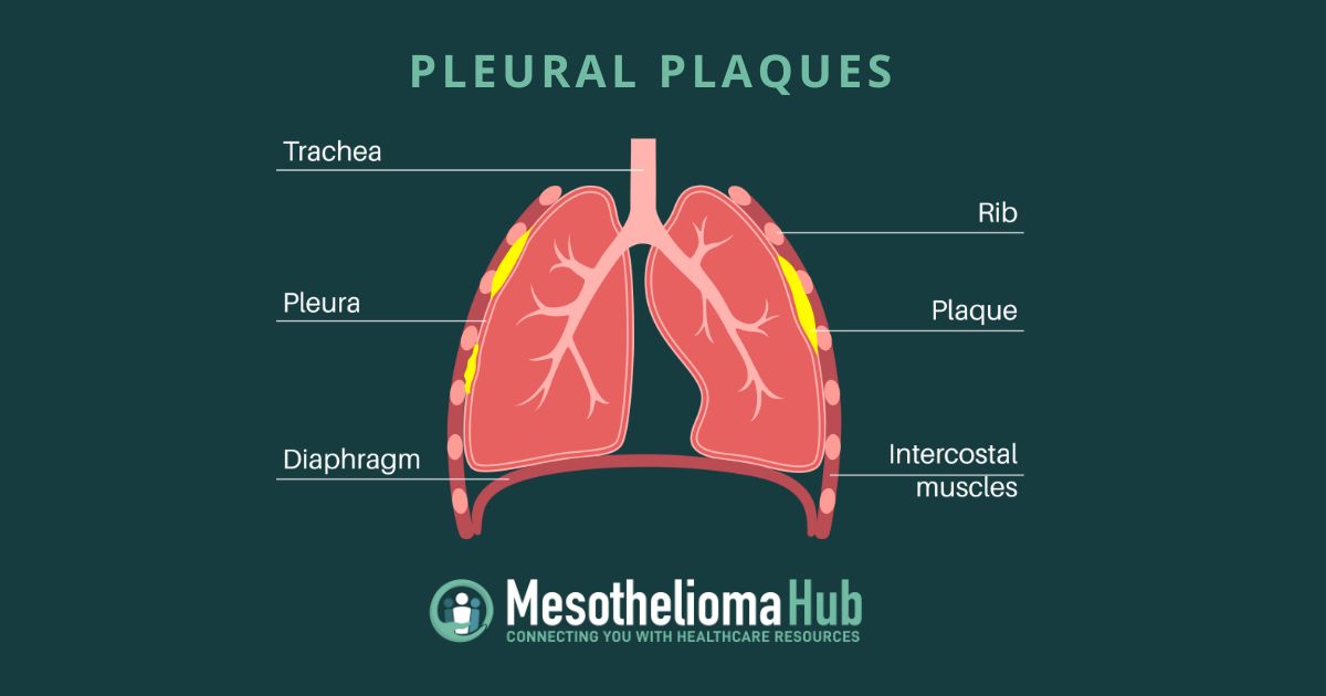 Pleural Plaques Infographic showing the different parts of the lung including the pleural and plaques.