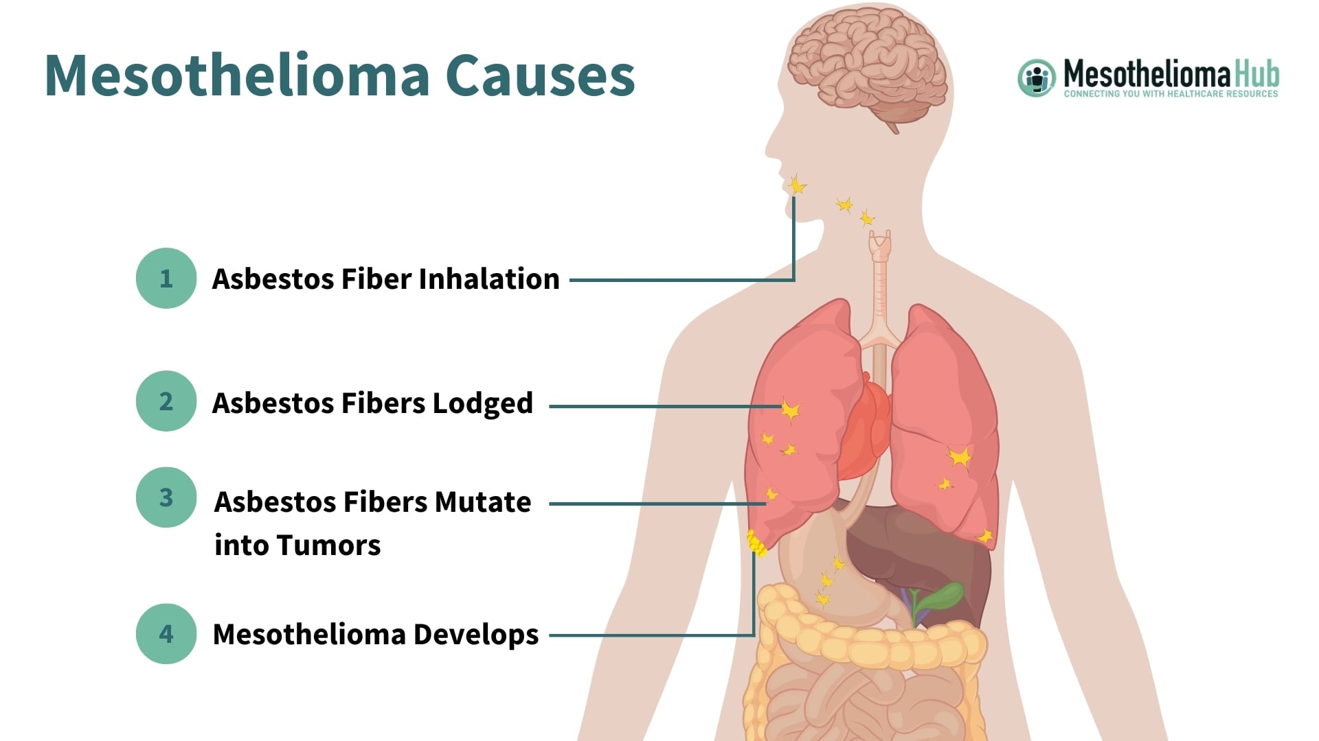 Infographic showing a cause of mesothelioma, asbestos, and how it affects the body and develops tumors