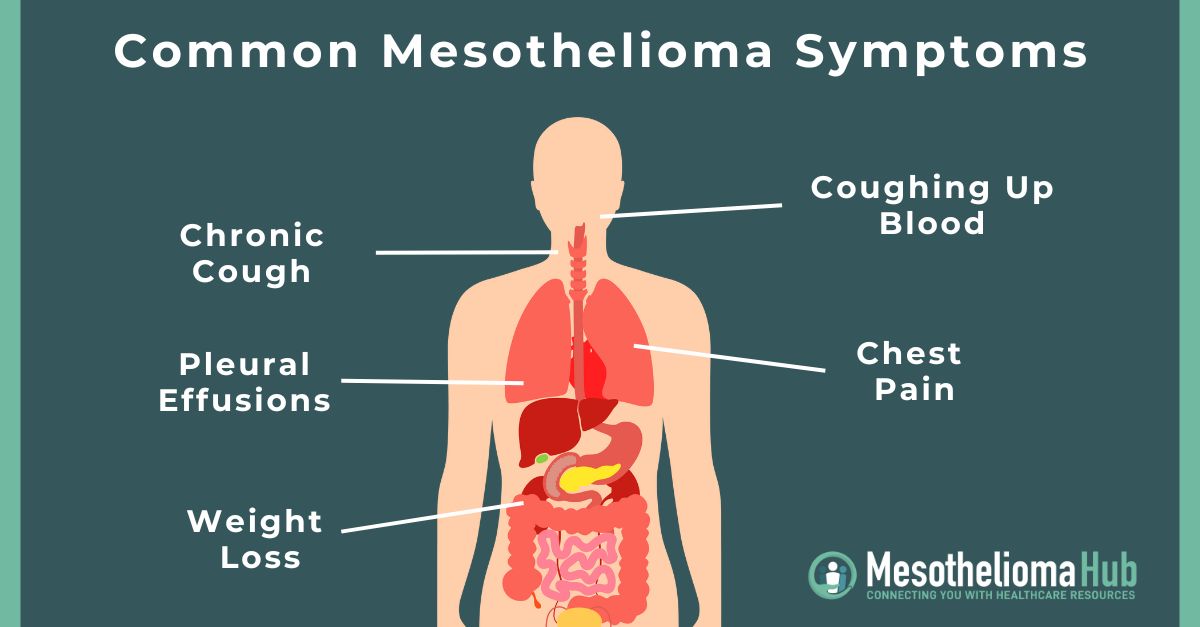 Common Mesothelioma Symptoms showing the location of each symptom including; chronic cough pointing to the throat, coughing up blood pointing to the mouth, pleural effusions pointing to the lungs, and weight loss pointing to the stomach.