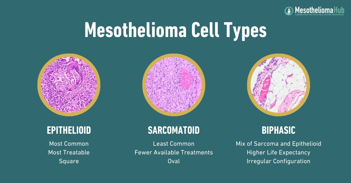 Mesothelioma Cell Types infographics showing Three cell types side by side, with Sarcomatoid in the middle as the largest and the other two in smaller circles to the left and right, epithelioid and biphastic.
