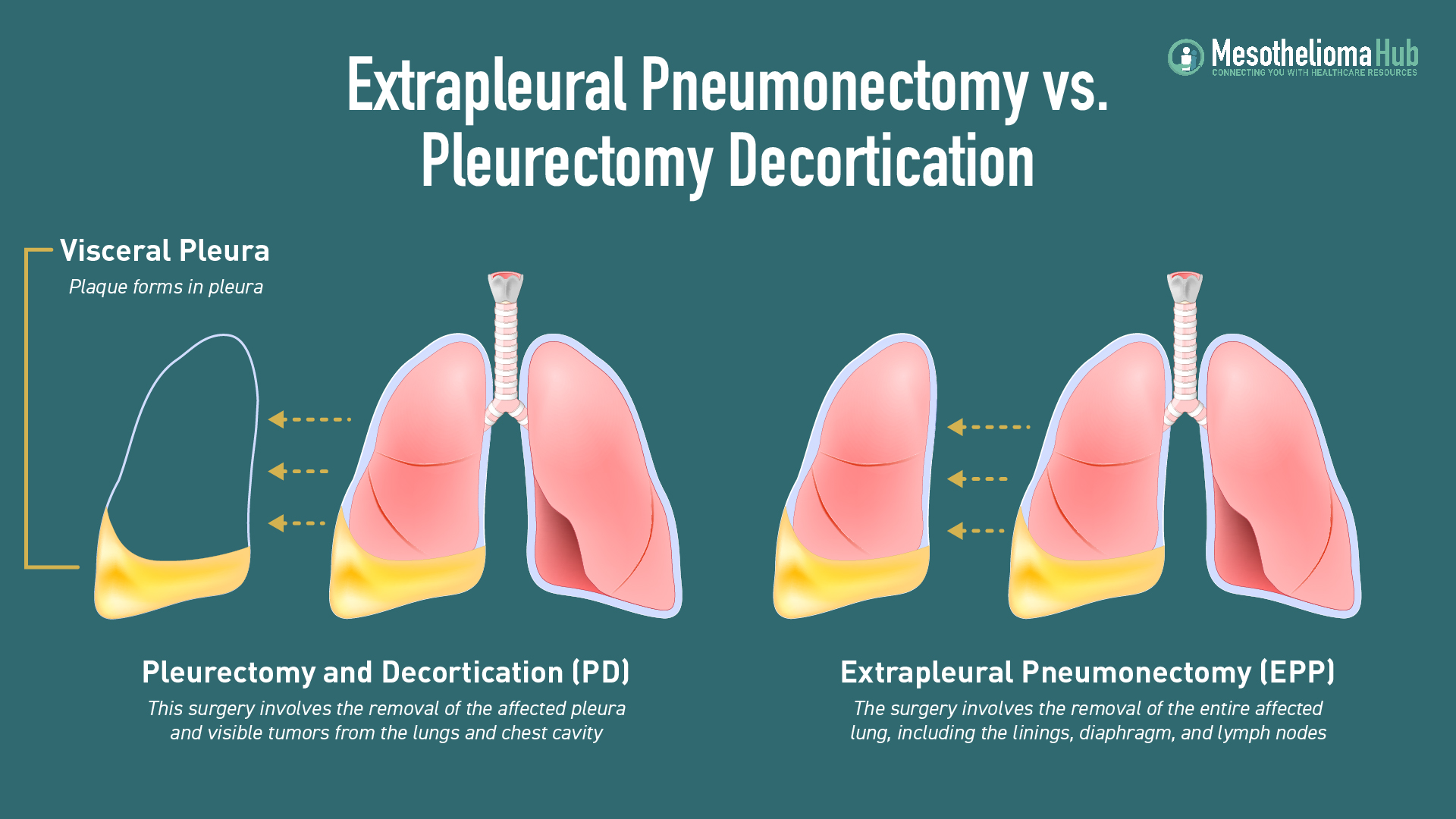 Extrapleural Pneumonectomy vs. Pleurectomy Decortication infographic showing the differences in the lungs.
