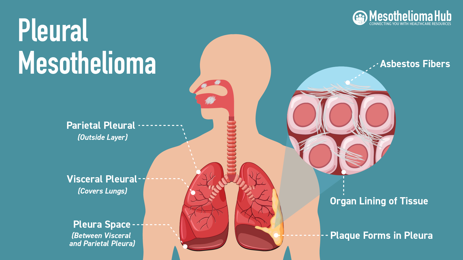 Pleural mesothelioma infographic showing Parietal Pleural (Outside Layer), Visceral Pleural (Covers Lungs), Pleura Space (Between Visceral and Parietal Pleura), Asbestos Fibers, Organ Lining of Tissue and Plaque Forms in Pleura