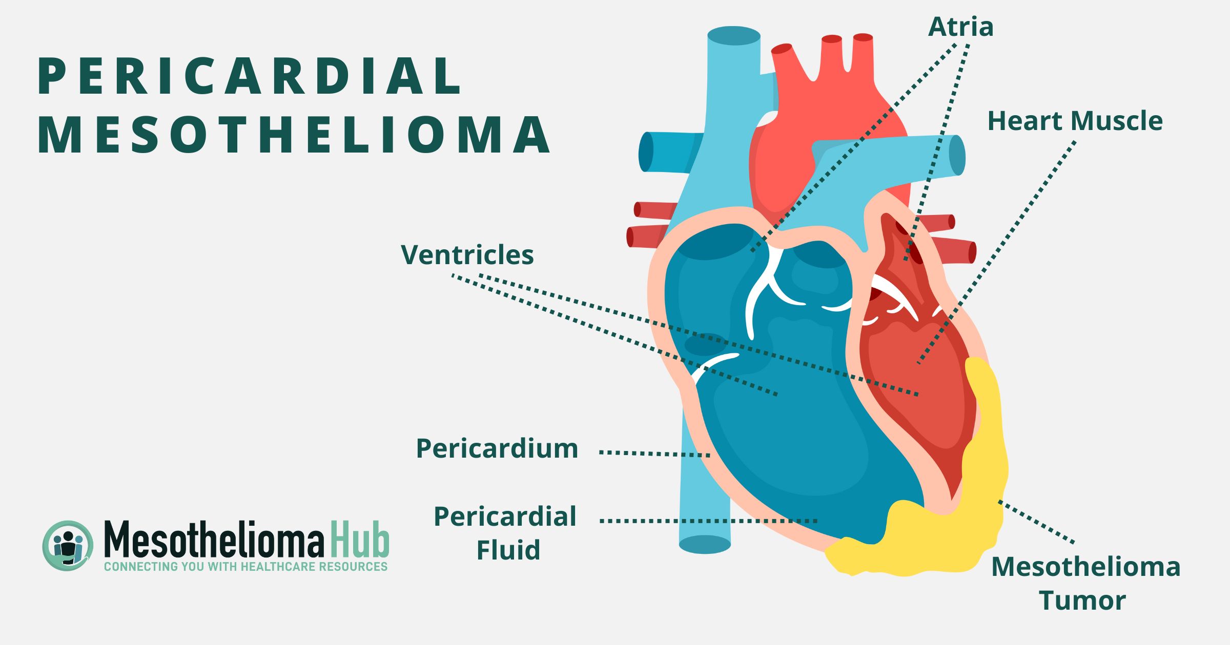 Pericardial Mesothelioma infographic showing the heart muscle, mesothelioma tumor, pericardium, ventricles, pericardial fluid, and atria.