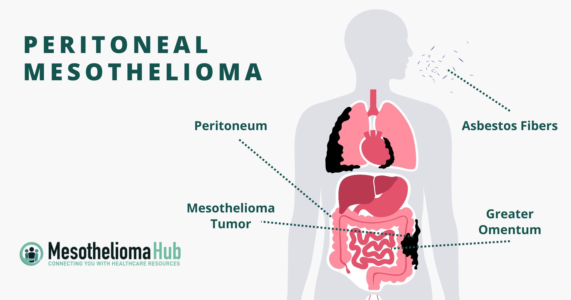 Peritoneal mesothelioma infographic image of a person inhaling asbestos fibers with callouts to the listed and a focus on the abdomen: Asbestos Fibers (Being inhaled, show going down body lodging in the abdomen) Peritoneum: Thin lining surrounding abdominal organs, Mesothelioma Tumor: Forms in peritoneum, Greater Omentum: Visceral peritoneum that hangs down from the stomach